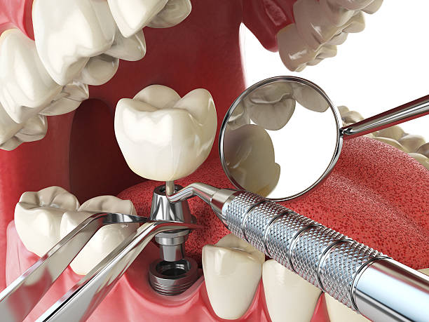Best Broken or Cracked Tooth Emergency Dentist in Newnan, GA